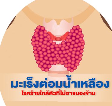 คุณหมอรับรักษาโรคมะเร็งน้ำเหลือง โรคคล้ายมะเร็ง